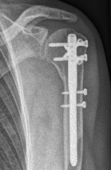 Proximaler Oberarmbruch8